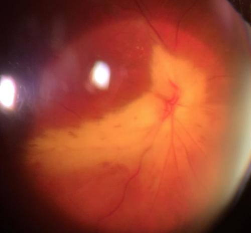 Myelinated retinal nerve fiber layer